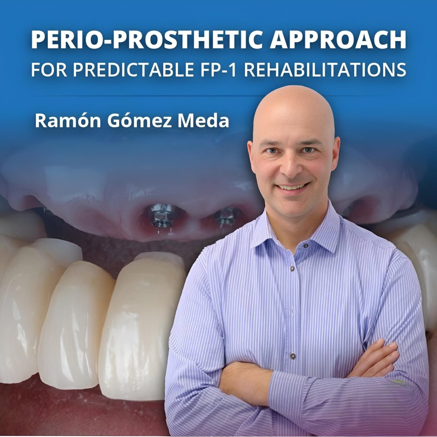 perio-prosthetic approach for fp1 rehabilitations