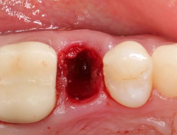 Extraction-Socket