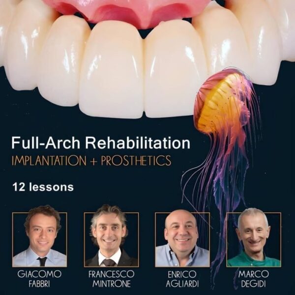 Full-Arch-Rehabilitation-Implantation-and-Prosthetics