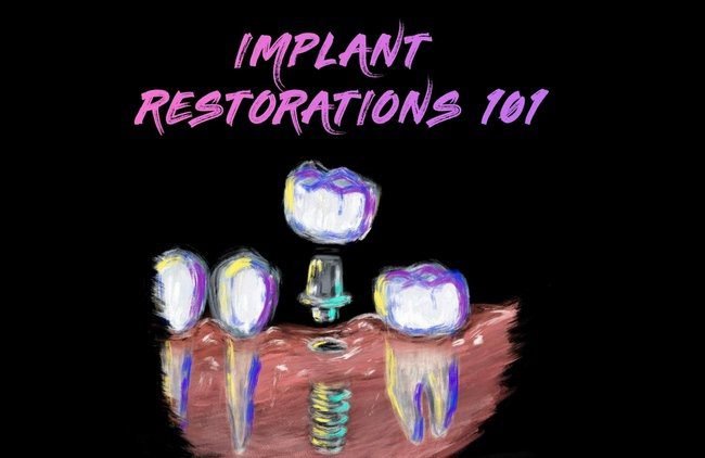 Implant-Restorations