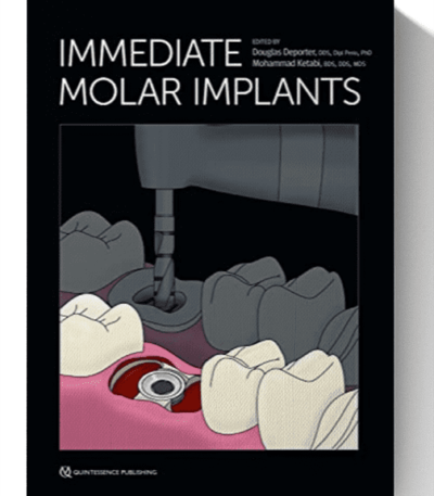 immediate molar implants