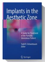 implants in the aesthetic zone