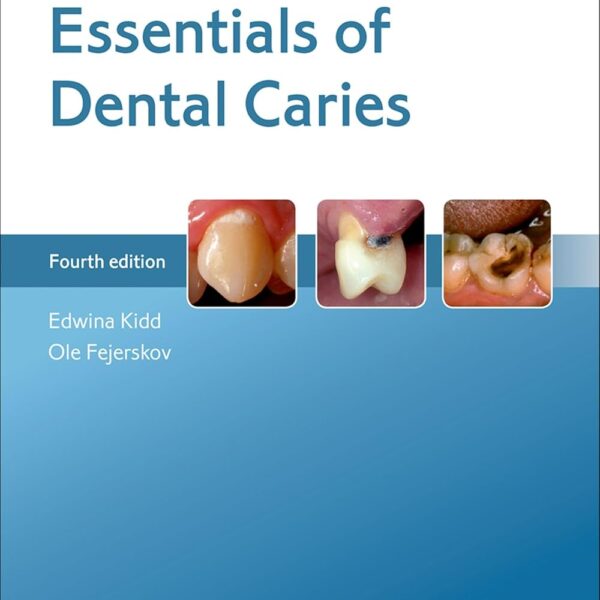 Essentials of Dental Caries