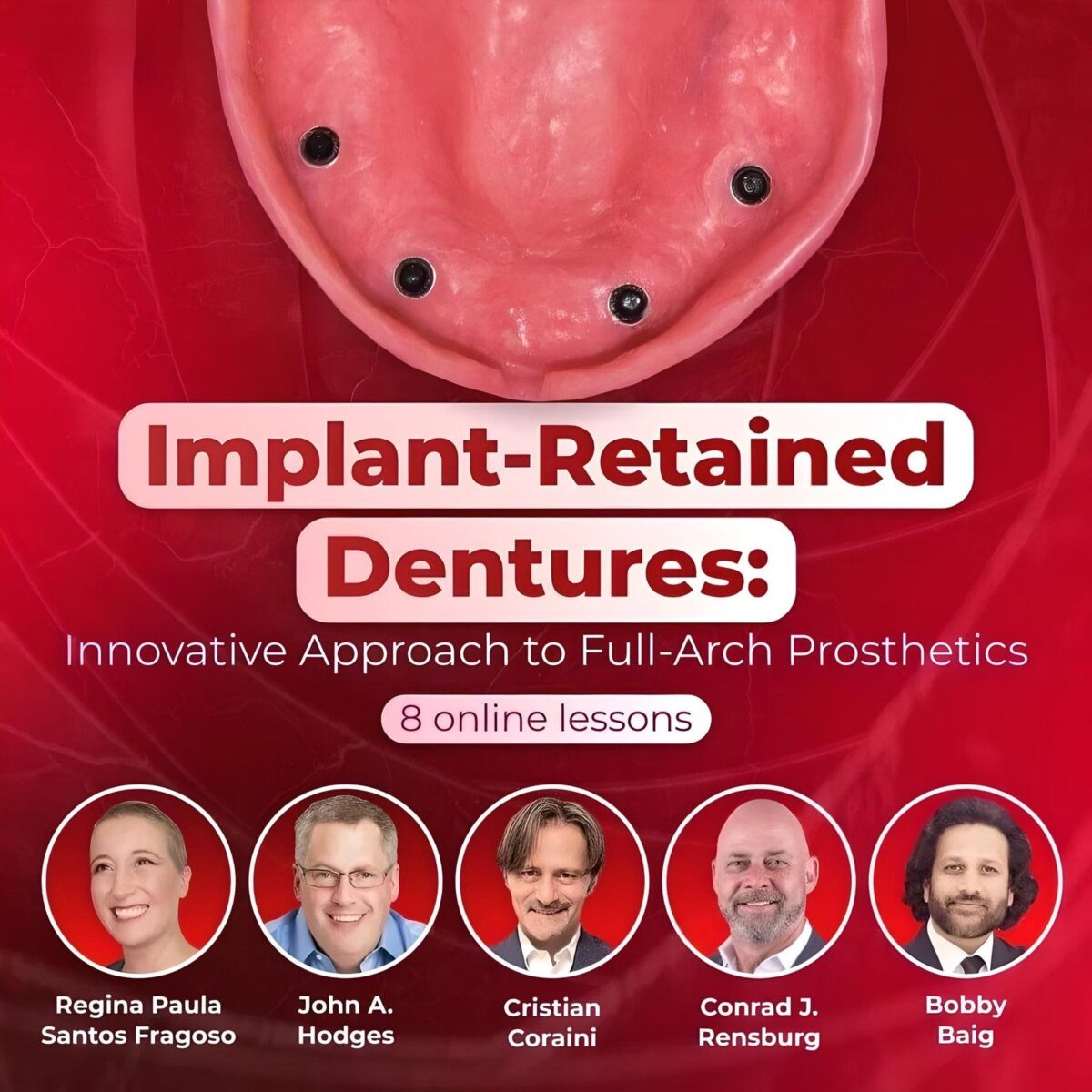 Implant-Retained Dentures: Innovative Approach to Full-Arch Prosthetics