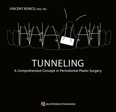 Tunneling-A-Comprehensive-Concept-in-Periodontal-Plastic-Surgery