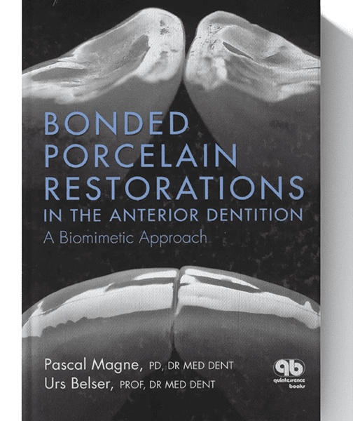 Bonded Porcelain Restorations in the Anterior Dentition