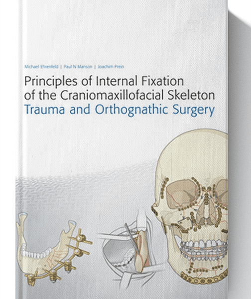 Principles of Internal Fixation of the Craniomaxillofacial Skeleton