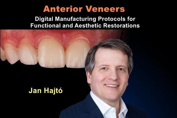 Anterior Veneers: Digital Manufacturing Protocols for Functional and Aesthetic Restorations
