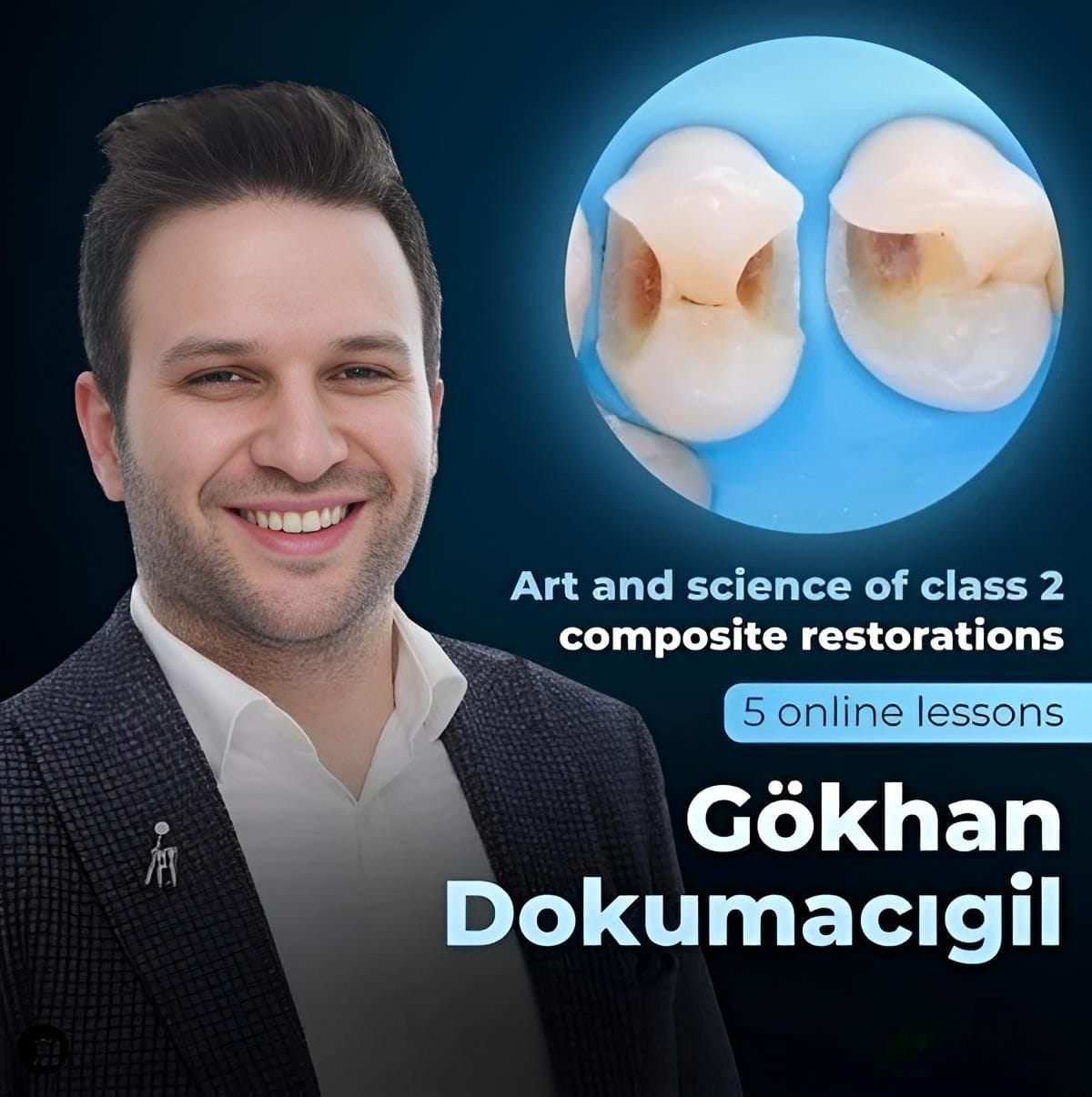 Art and Science of Class 2 Composite Restorations