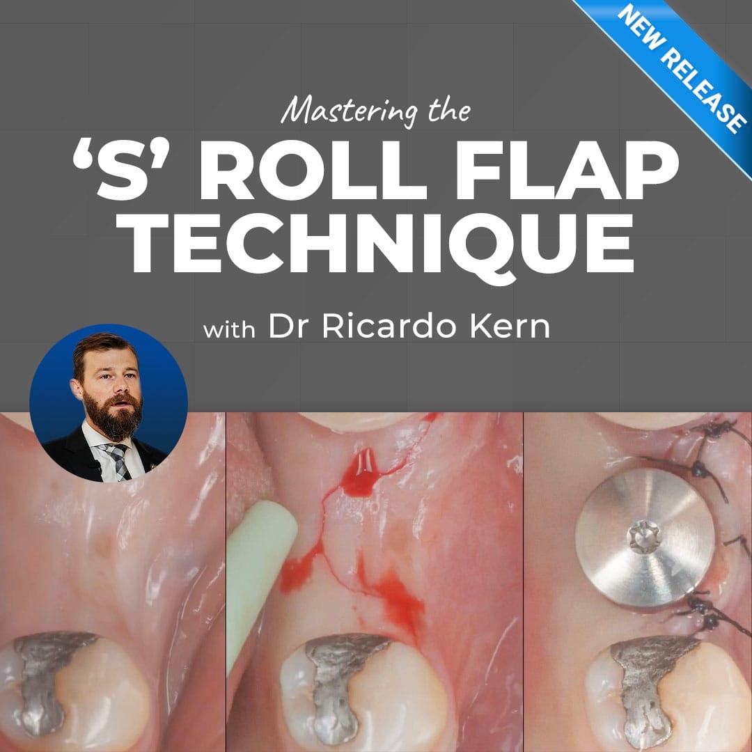 The S Roll Flap Technique