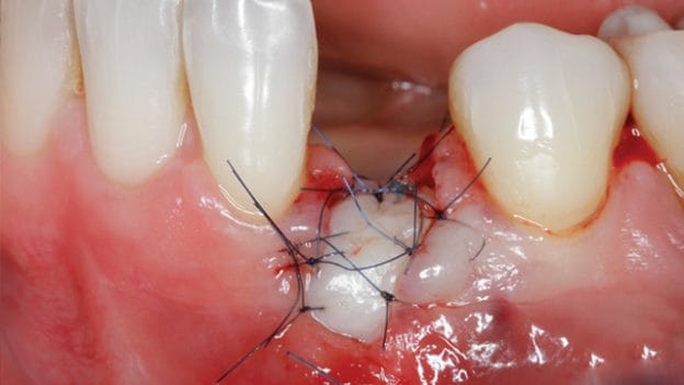 Soft Tissue Management around Natural Teeth and Dental Implants: Fundamentals, Evidence Based and Surgical Innovations