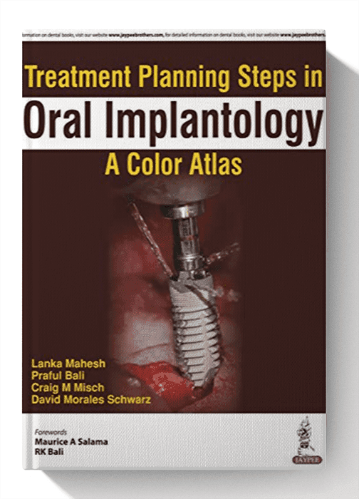 Treatment Planning Steps in Oral Implantology: A Color Atlas