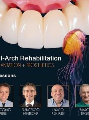 Full-Arch-Rehabilitation-Implantation-and-Prosthetics