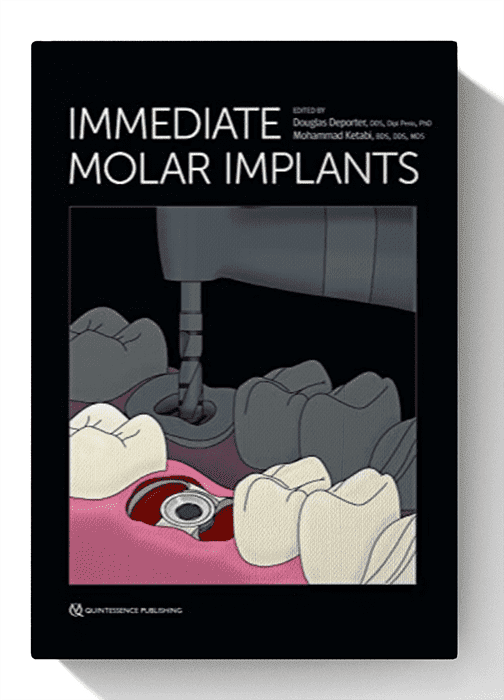 immediate molar implants