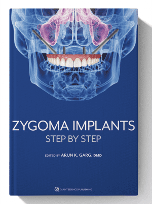 zygoma implants