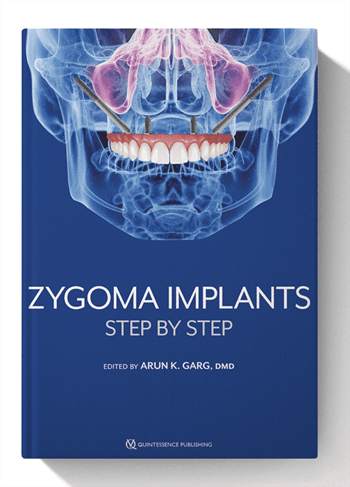 zygoma implants