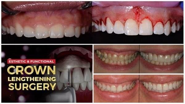 Esthetic-and-Functional-Crown-Lengthening